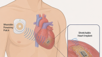 wireless-medical-implants